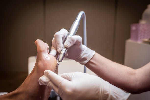 Why Painful Corns Keep Coming Back (And What People Often Get Wrong)